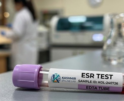 ESR (Erythrocyte Sedimentation Rate) Test 2 ESR (Erythrocyte Sedimentation Rate) Test - Image 2