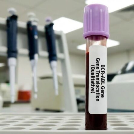 Bcr-Abl Gene Translocation (Qualitative)