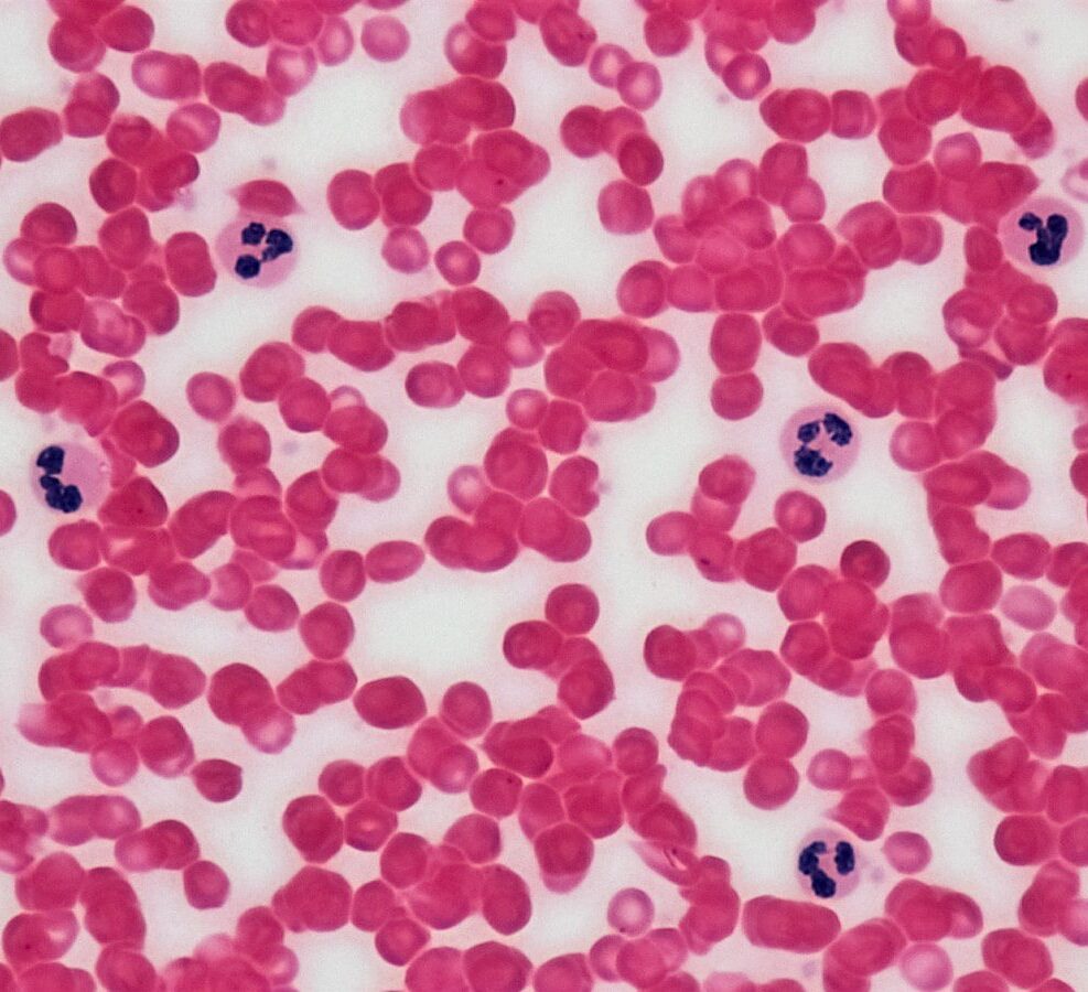 Blood Picture (P/S) Gbp 5 Connective Tissue: Human Blood Leukocyte Survey