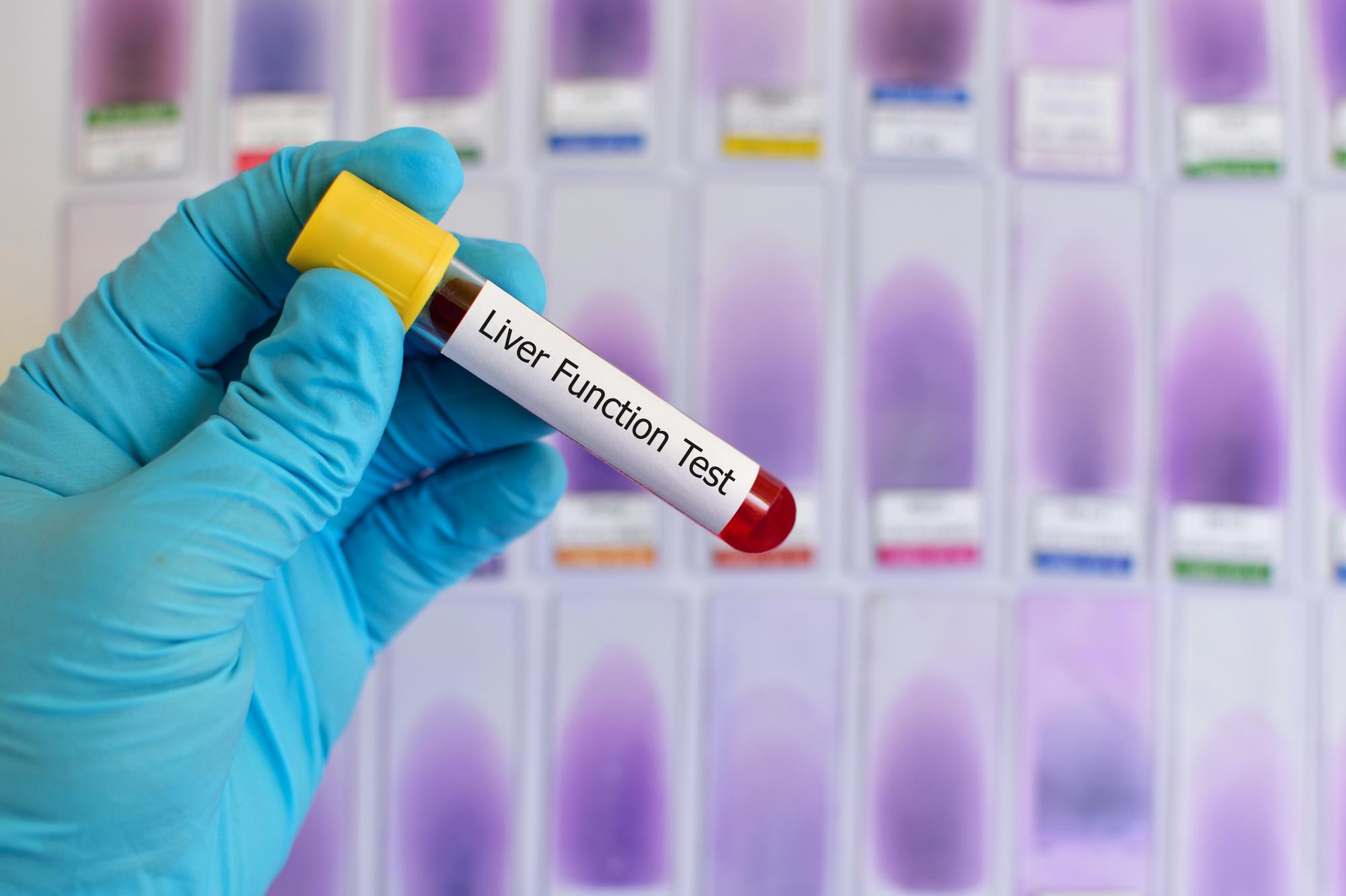 Liver Function Test (LFT) - Image 2
